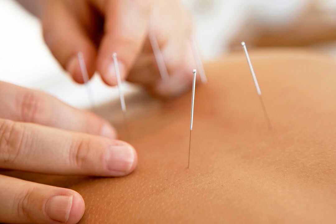 Gücü artırmak için akupunktur
